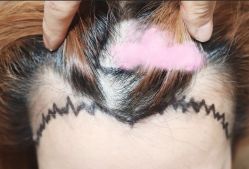 -大麦微针植发全国连锁