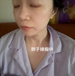 -爱莎扁平疣·汗管瘤·斑痣中心
