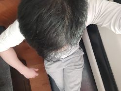 -碧莲盛·不剃发植发