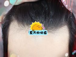 -大麦微针植发全国连锁