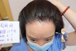 -大麦微针植发丨全国连锁