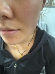 体验后-北京美痣堂古方祛痣斑疣瘊
