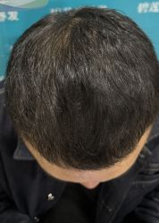 -碧莲盛·不剃发植发