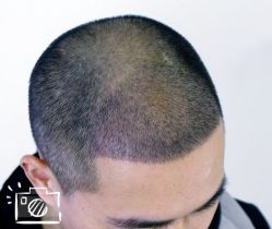 -大麦微针植发丨全国连锁