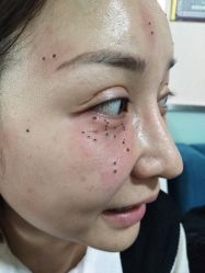 -北京美痣堂古方祛痣斑疣瘊