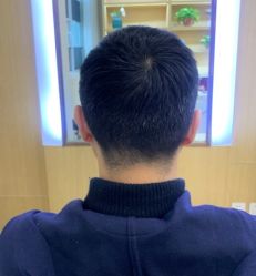 -大麦微针植发全国连锁