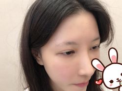 -大麦微针植发丨全国连锁