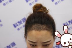 -大麦微针植发丨全国连锁