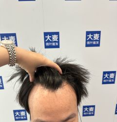 体验前-大麦微针植发全国连锁