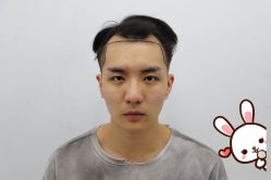 -大麦微针植发丨全国连锁