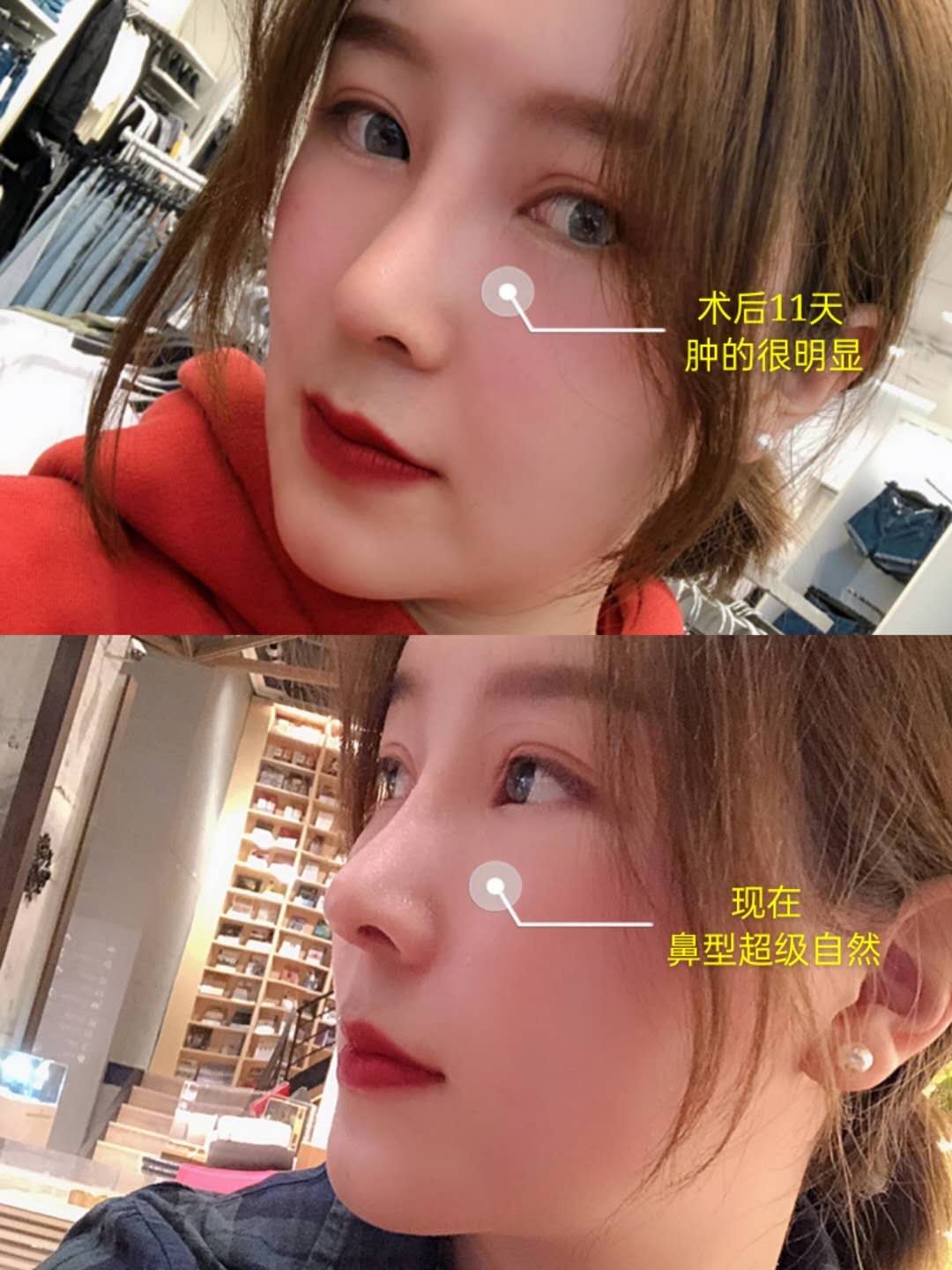 隆鼻后应该注意什么才会恢复的更快?