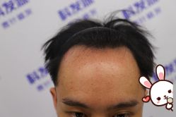 -大麦微针植发丨全国连锁