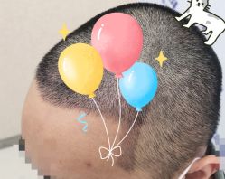 -大麦微针植发全国连锁