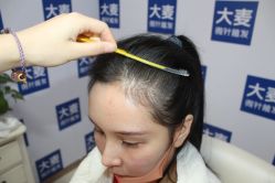 -大麦微针植发丨全国连锁
