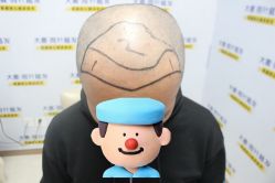 -大麦微针植发丨全国连锁