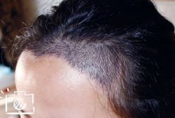 -大麦微针植发丨全国连锁