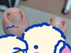 -世龙世家灰指甲鸡眼脚气甲沟炎跖疣护理(通州店)