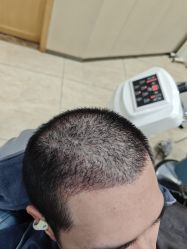 -大麦微针植发全国连锁