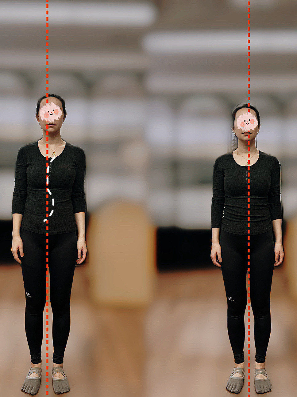 脊柱侧弯c和s型