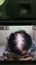 体验前-大麦微针植发全国连锁