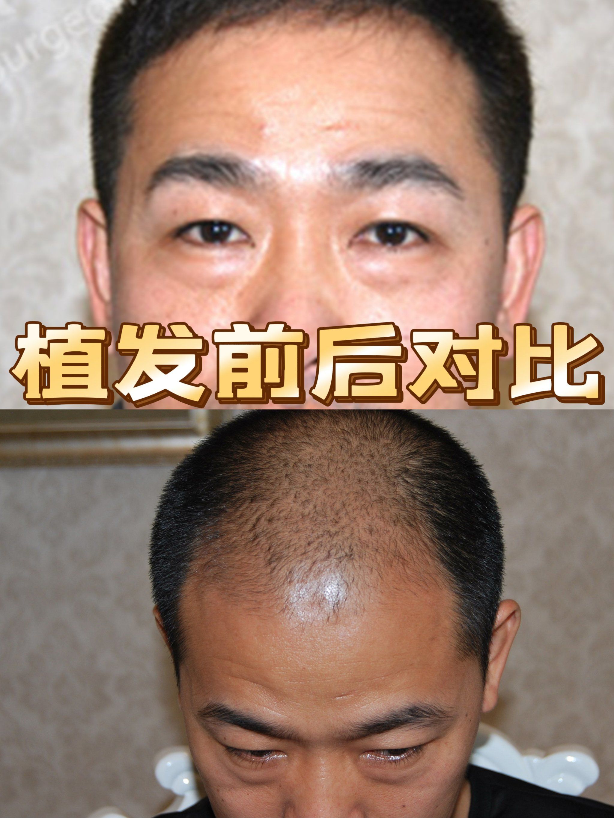 植发效果大揭秘!