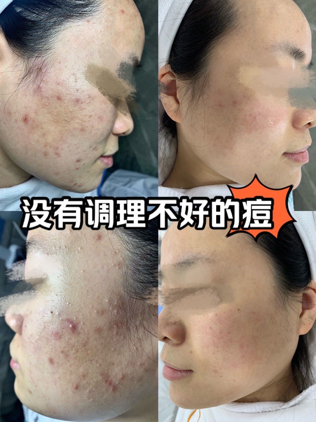痘痘效果对比图