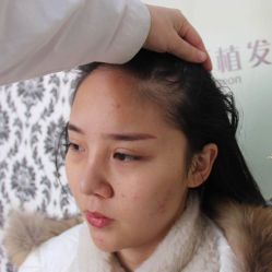 -大麦微针植发丨全国连锁