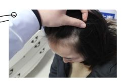 -大麦微针植发全国连锁