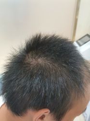 -碧莲盛·不剃发植发