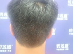 -碧莲盛·不剃发植发