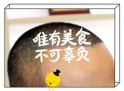 -大麦微针植发全国连锁