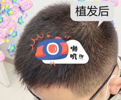 -大麦微针植发全国连锁