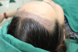 -大麦微针植发丨全国连锁