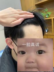 -大麦微针植发全国连锁