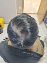 -大麦微针植发丨全国连锁