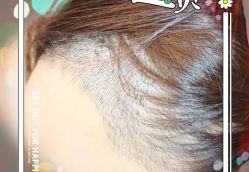 -大麦微针植发全国连锁