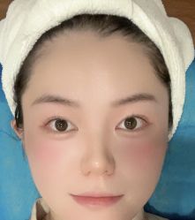 体验后-四川娇点医学美容医院