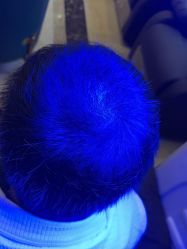 -碧莲盛·不剃发植发