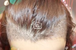 -大麦微针植发全国连锁