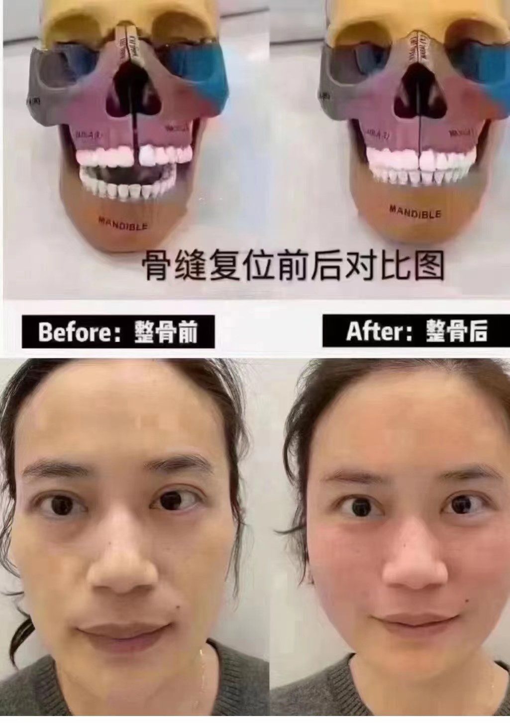 今天我也终于体验了一把小颜整骨!经常听闺