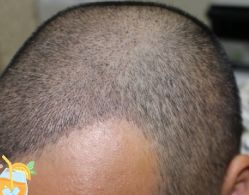 -大麦微针植发丨全国连锁