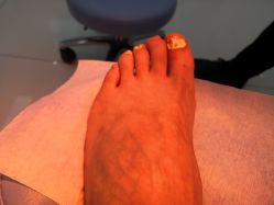 -派恩宜灰指甲鸡眼嵌甲手足癣