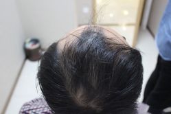 点击看大图 -大麦微针植发丨全国连锁