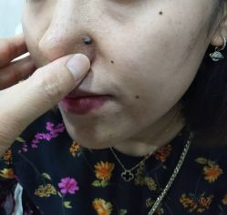 点击看大图 -北京美痣堂古方祛痣斑疣瘊