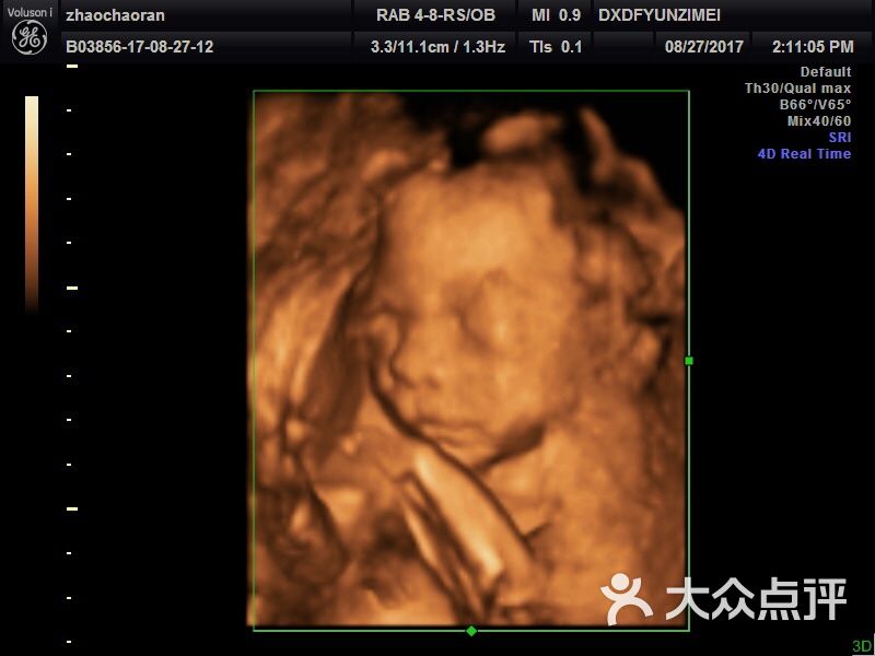 怀孕10周四维彩超图图片