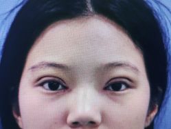 体验后-西安壹加壹医疗美容·西北抗衰旗舰店