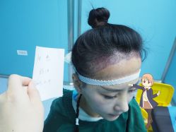 -大麦微针植发丨全国连锁