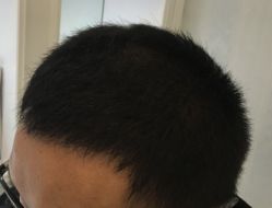 -大麦微针植发全国连锁