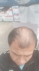 -碧莲盛·不剃发植发