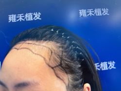 -雍禾植发全国连锁